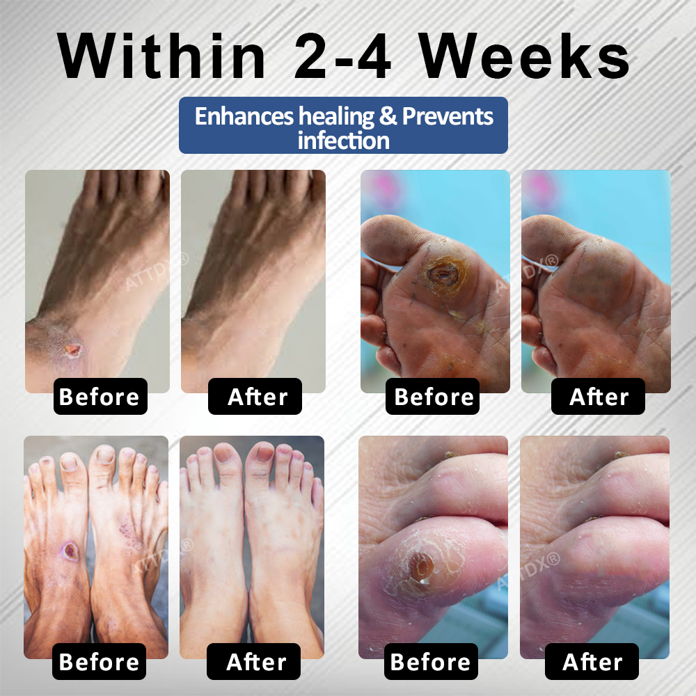 CVREOZ® Diabetes Foot Guard Fast Recovery Spray