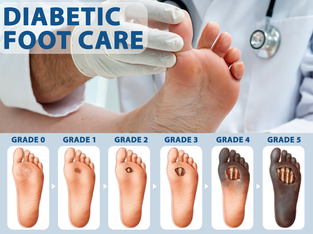 CVREOZ® Diabetes Foot Guard Fast Recovery Spray