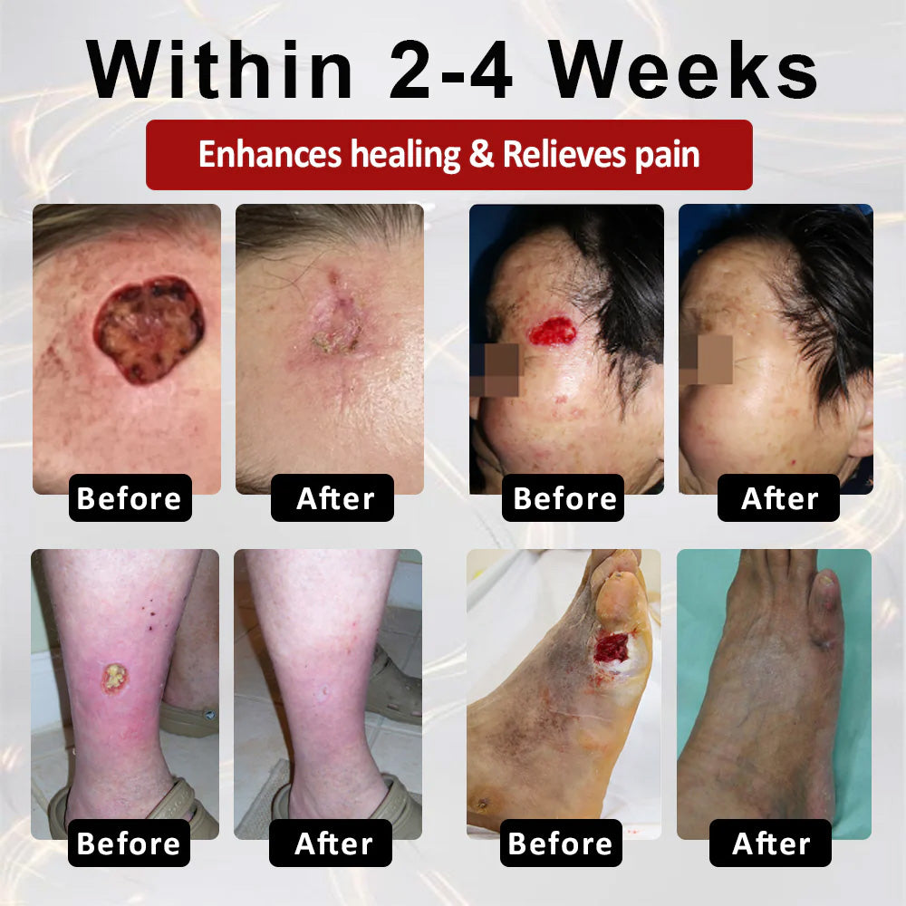 LIMITED TIME SALE OFF 70% 🔥CVREOZ® DiaCure Bee Venom & Centella Diabetic Foot Ulcer Spray