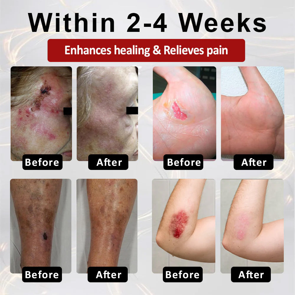 LIMITED TIME SALE OFF 70% 🔥CVREOZ® DiaCure Bee Venom & Centella Diabetic Foot Ulcer Spray