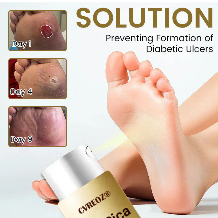 LIMITED TIME SALE OFF 70% 🔥CVREOZ® DiaCure Bee Venom & Centella Diabetic Foot Ulcer Spray