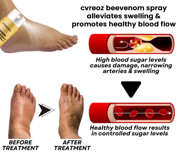 đSPECIAL OFFER: 60% OFF This Today Only!đ„CVREOZÂź Bee Venom Diabetic Foot Treatment Spray