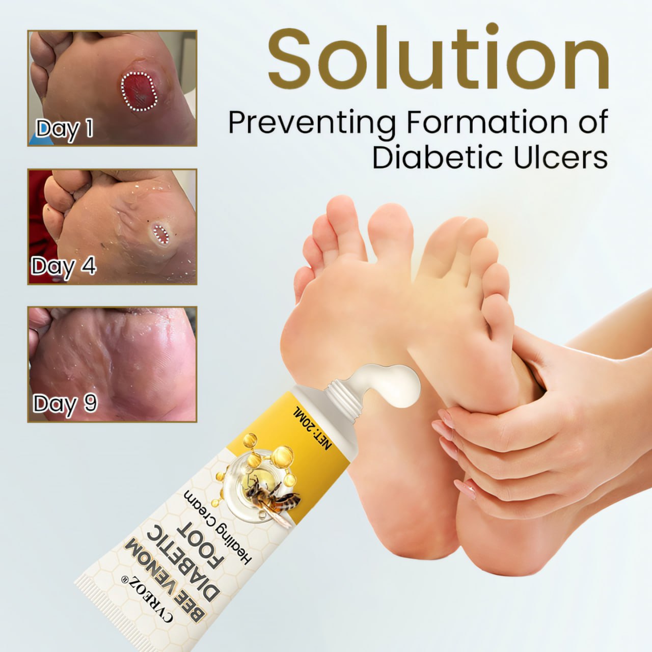 🎉SPECIAL OFFER: 60% OFF🔥 8M+ SOLD️🏆 CVREOZ® Bee Venom Diabetic Foot Healing Cream