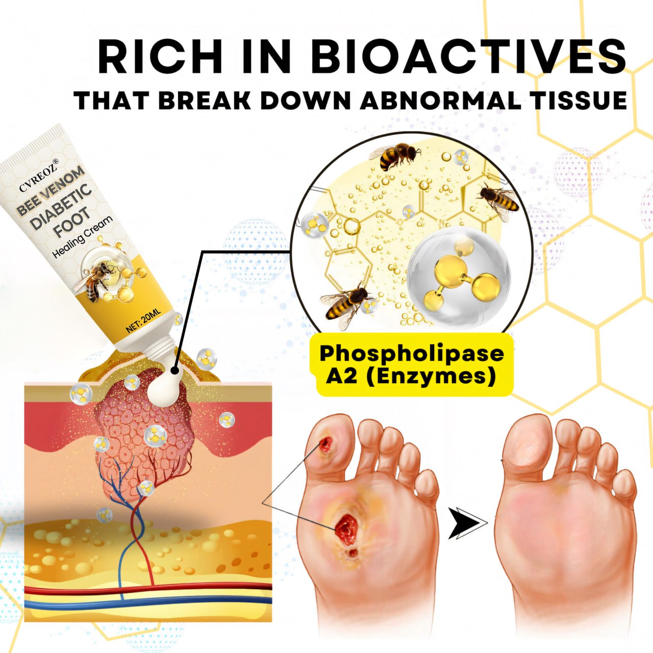 🎉SPECIAL OFFER: 60% OFF🔥 8M+ SOLD️🏆 CVREOZ® Bee Venom Diabetic Foot Healing Cream