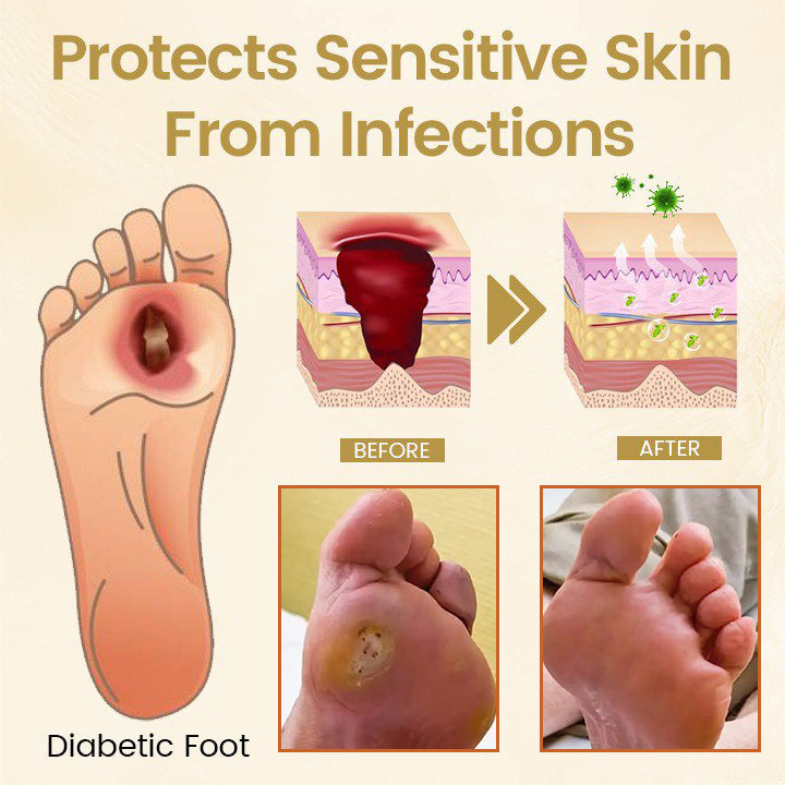 ⏰Last Day Promotion: 60% OFF 🔥 CVREOZ® Bee Venom Diabetic Foot Healing Spray