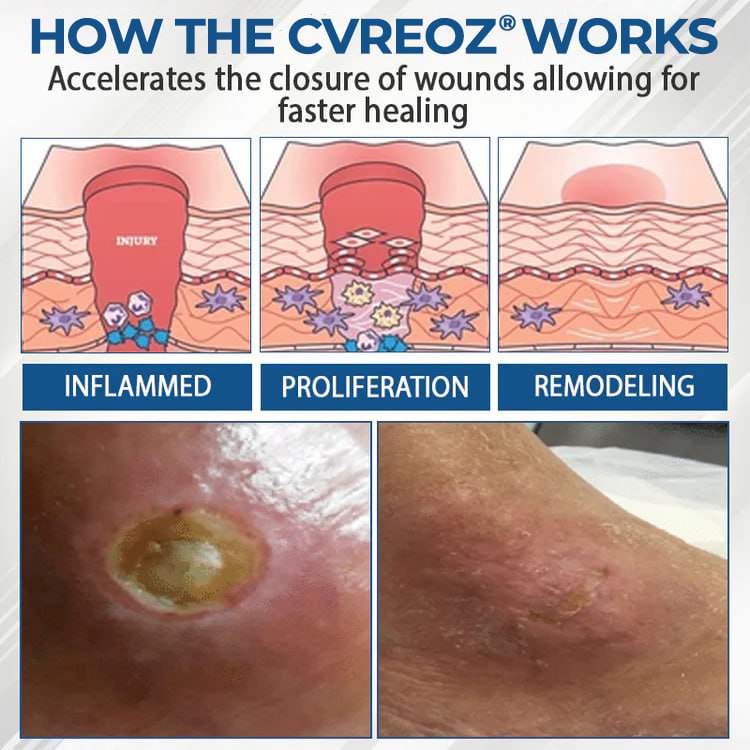 CVREOZ® Diabetes Foot Guard Fast Recovery Spray
