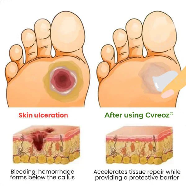 CVREOZ® Diabetic's Foot Cream