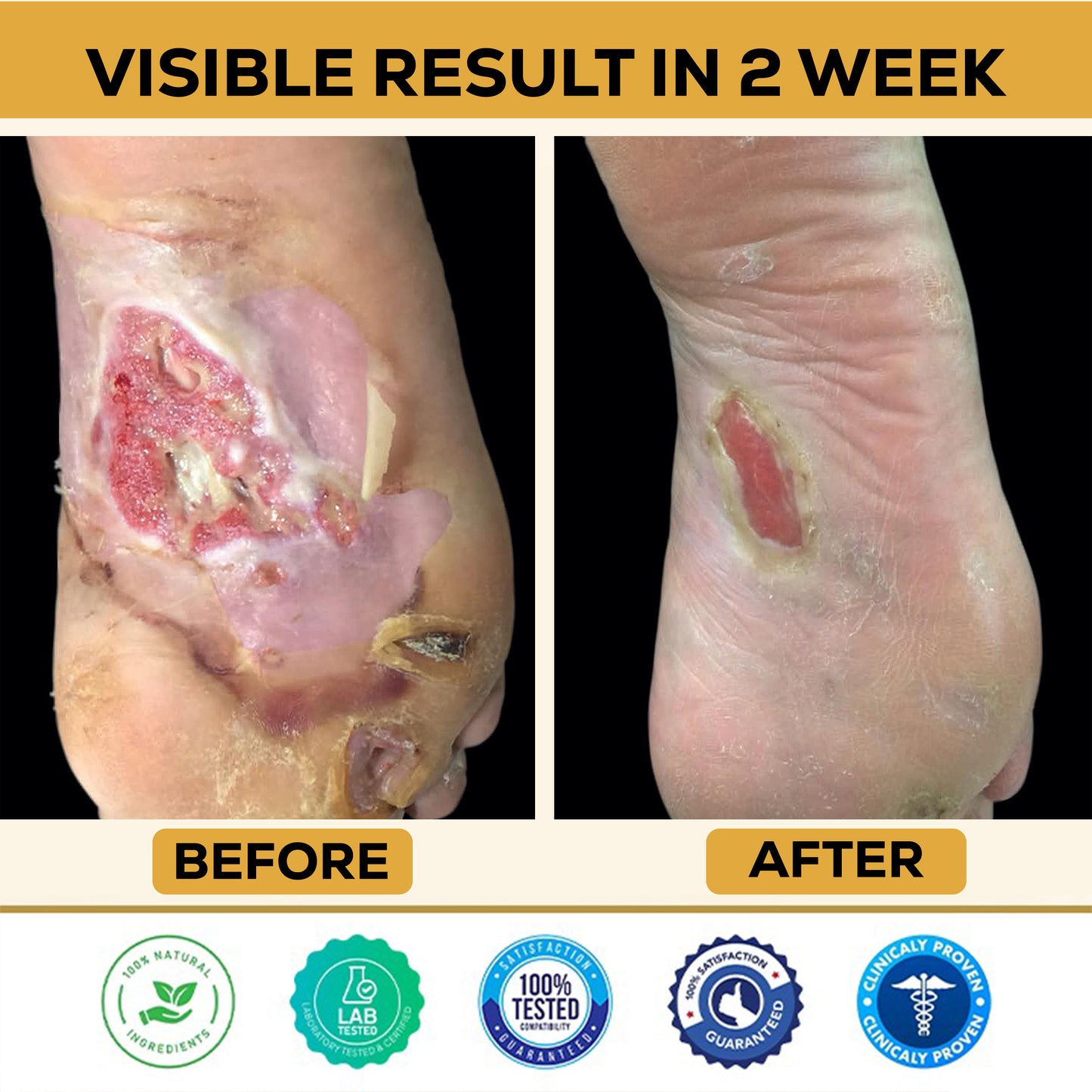 🎉SPECIAL OFFER: 60% OFF This Today Only!🔥 CVREOZ® Bee Venom Diabetic Foot Healing Spray