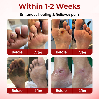 CVREOZ® DiaCare Diabetic Treatment Cream