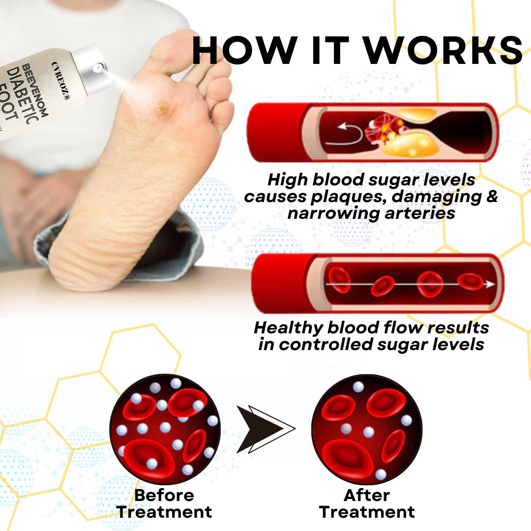 🔥HOT SALE 60% OFF✨ CVREOZ® Bee Venom Diabetic Foot Healing Spray