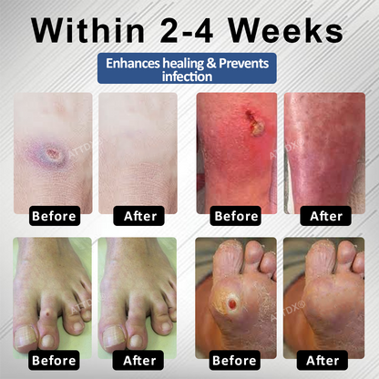 CVREOZ® Diabetes Foot Guard Fast Recovery Spray