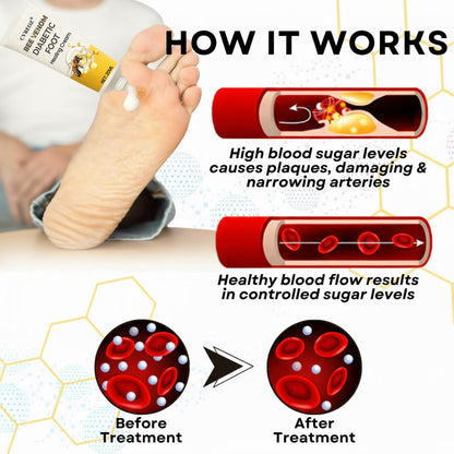 🎉SPECIAL OFFER: 60% OFF🔥 8M+ SOLD️🏆 CVREOZ® Bee Venom Diabetic Foot Healing Cream