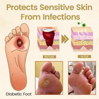 🎉SPECIAL OFFER: 60% OFF🔥 8M+ SOLD️🏆 CVREOZ® Bee Venom Diabetic Foot Healing Cream