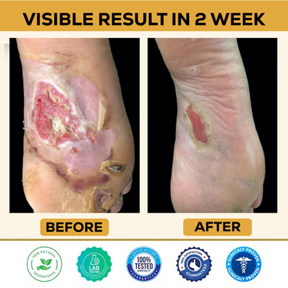 ⏰Last Day Promotion: 60% OFF 🔥 CVREOZ® Bee Venom Diabetic Foot Healing Spray