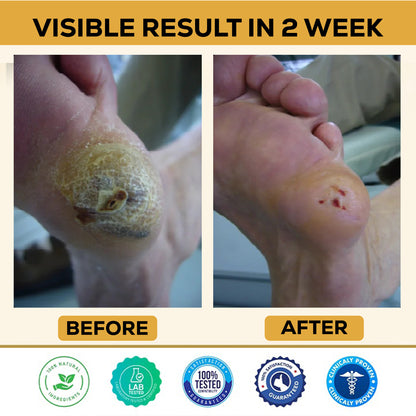 ⏰Last Day Promotion: 60% OFF 🔥 CVREOZ® Bee Venom Diabetic Foot Healing Spray