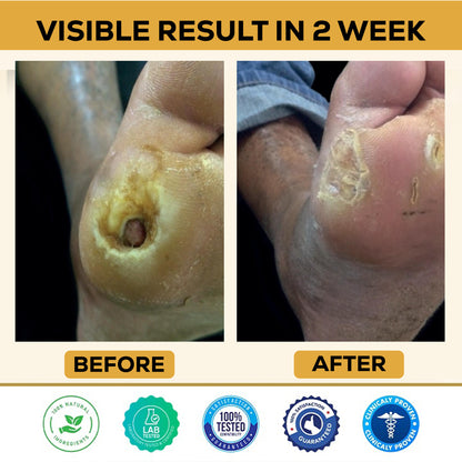 ⏰Last Day Promotion: 60% OFF 🔥 CVREOZ® Bee Venom Diabetic Foot Healing Spray